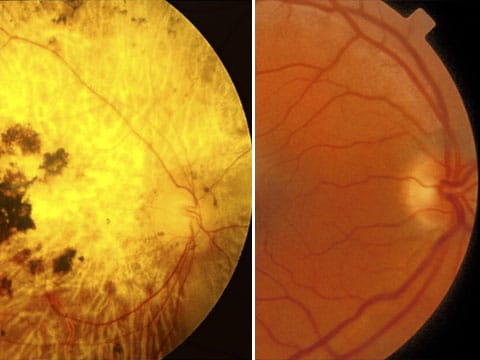 Oko slepých lidé (vlevo) a zdravých (vpravo)